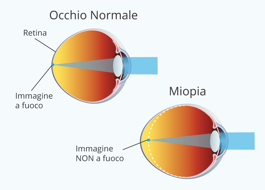 Miopia: sintomi e correzioni 7